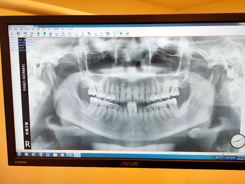 安曼牙醫-西瓜媽的全口X光片