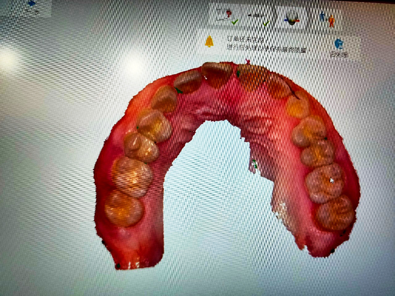 安曼牙醫-西瓜媽人生的第一張口腔掃描照